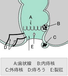 痔イメージ