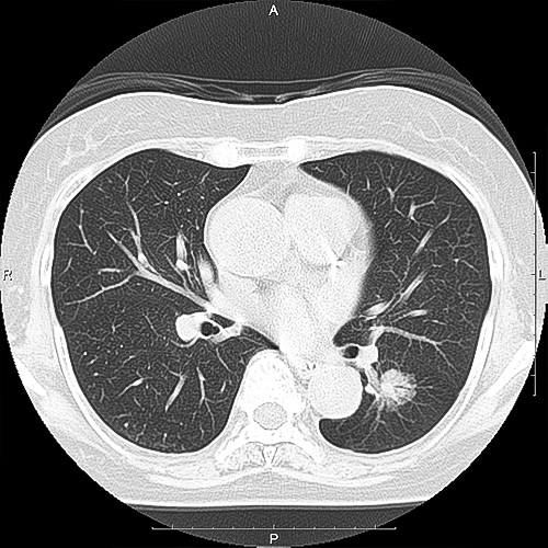 肺ガン検診イメージ
